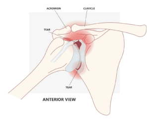 SLAP Tears, who, why, when and what