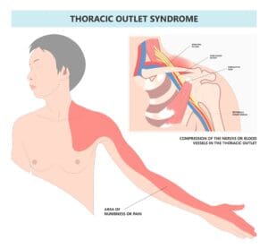 Thoracic outlet syndrome : evaluation and management simplified