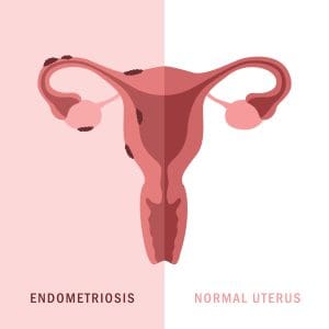 Rehabilitation for the patient with Endometriosis