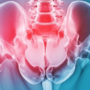 Hip dysplasia_tiny